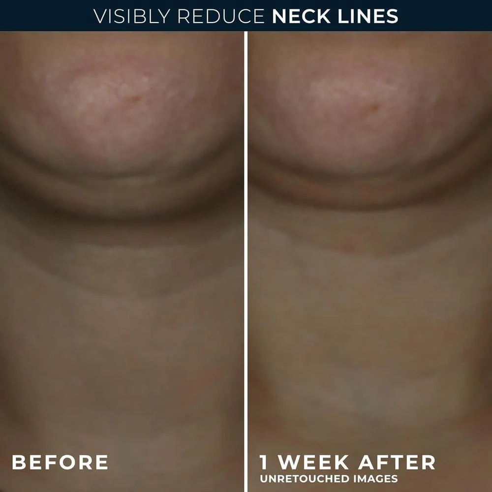 Roc Derm Correxion Crema Para El Cuello Con Ácido Hialurónico Y Retinol Avanzado 50g